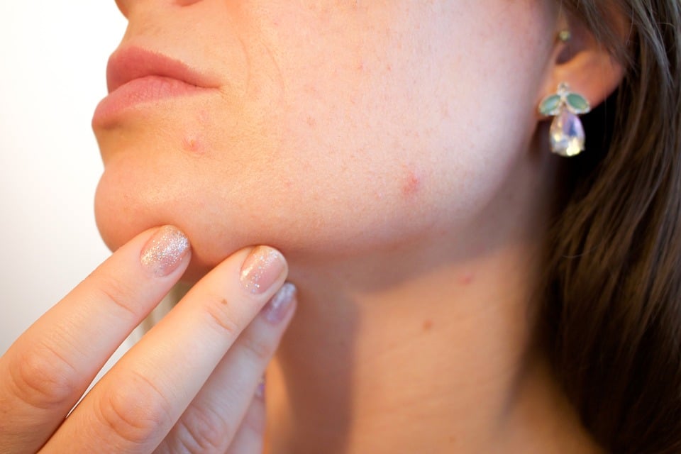 Acne, Pores, Skin, Pimple, Female, Face, Skincare
